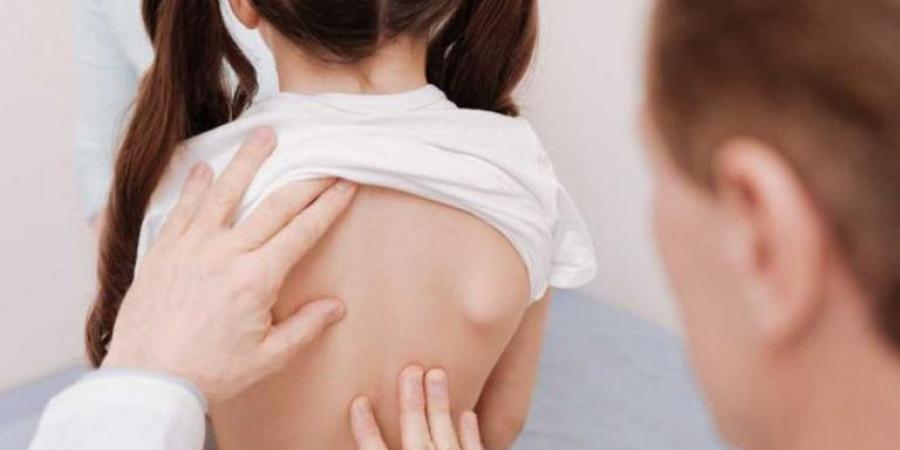 تشوه خفي قد يصيب طفلك..تعرف على إنحناء العمود الفقري ومضاعفاته - ايجي سبورت