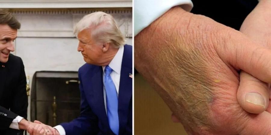 لماذا يضع ترامب المرهم على يده؟ البيت الأبيض يوضح - ايجي سبورت